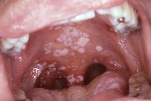 Triệu chứng bệnh lậu ở miệng